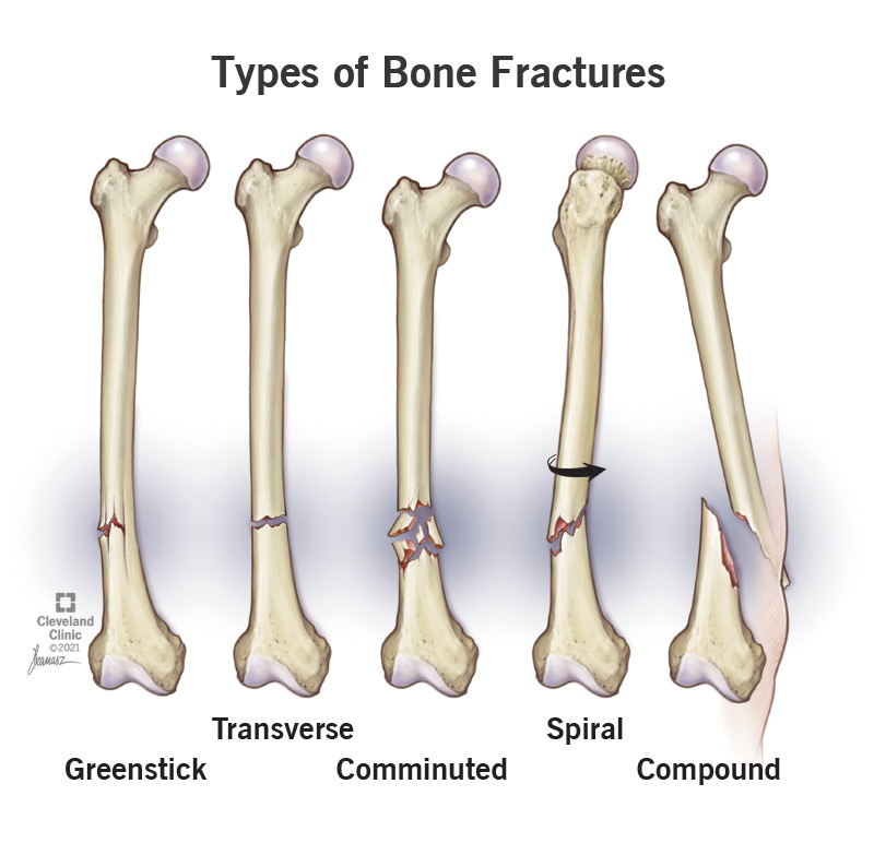 Bone Fracture