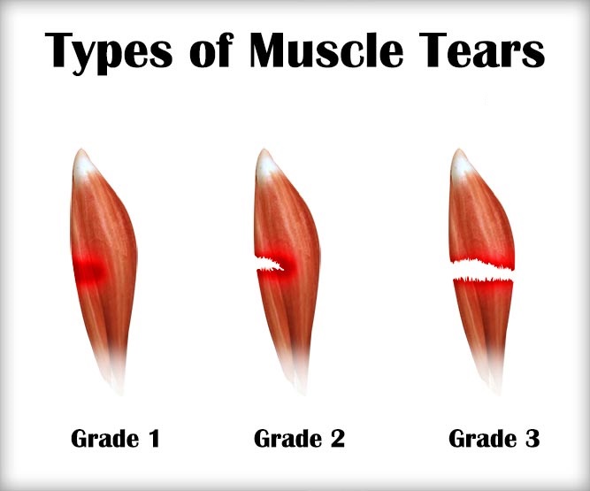 Muscle Strains and Tears